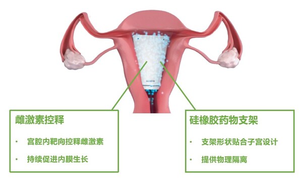 佩朵®置于宮腔內(nèi)，提供完整物理阻隔的同時(shí)，能夠在宮內(nèi)持續(xù)釋放雌激素藥物